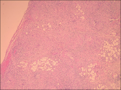 Low-power view showing peritoneal fat with extensive, well-defined, necrotizing granulomas.